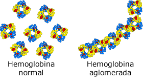 normal hemoglobin in normal red blood cell and clumped hemoglobin in sickle-shaped red blood cell